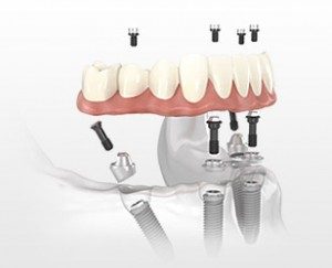 Implant dentures are permanent dentures available in Bloomington, IN.