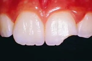 Close up photo of a patient's chipped tooth near Bloomington, IN.