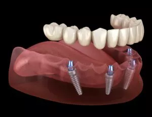 Implant Supported Dentures - Dentist in Bloomington IN - Create a Smile