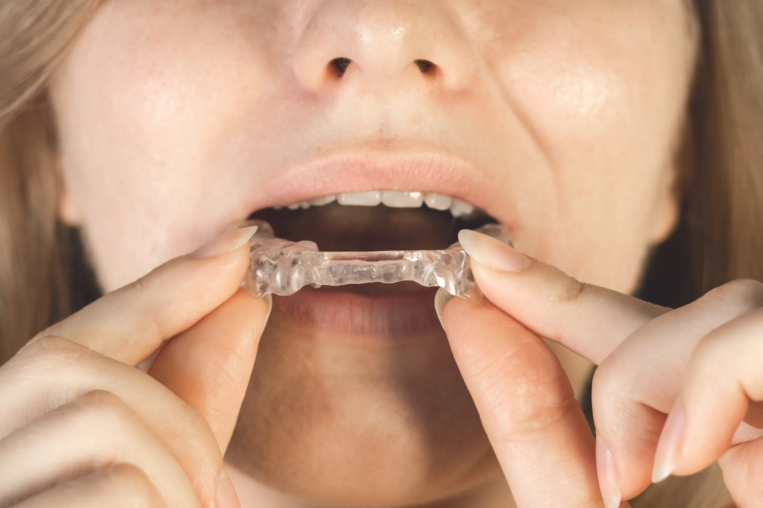 Woman puts dental guard in her mouth. TMJ splint disorder treatment. Occlusal splint. Prevent bruxism. Mouth guard for TMJ. Teeth protection. Pain in jaw. Teeth grinding